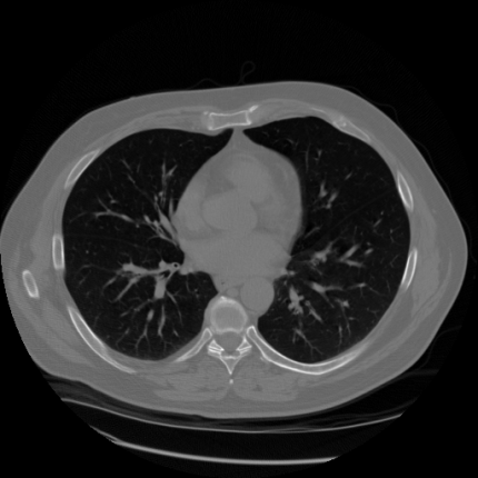 End to end analysis of non-small cell lung cancer using Low Dose CT images